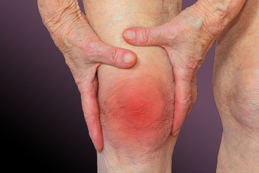 knie met arthritis
